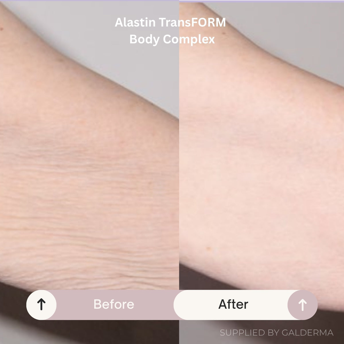 Before and after comparison of skin texture on a person's forearm, showing dry, wrinkled skin on the left and smoother, plumper skin on the right. Text at the top reads 'Alastin TransFORM Body Complex' and 'Before' / 'After' labels appear at the bottom.