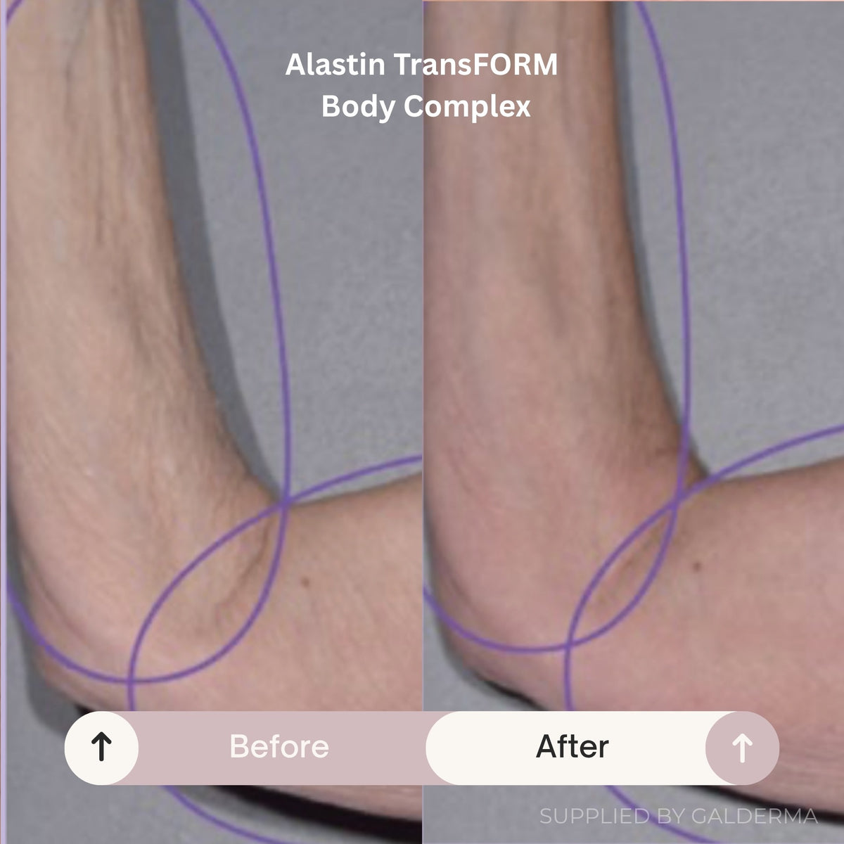 Before and after comparison of a skin fold on a person's ankle, showing skin tightening. The image includes the text 'Alastin TransFORM Body Complex' and 'Before' and 'After' labels.