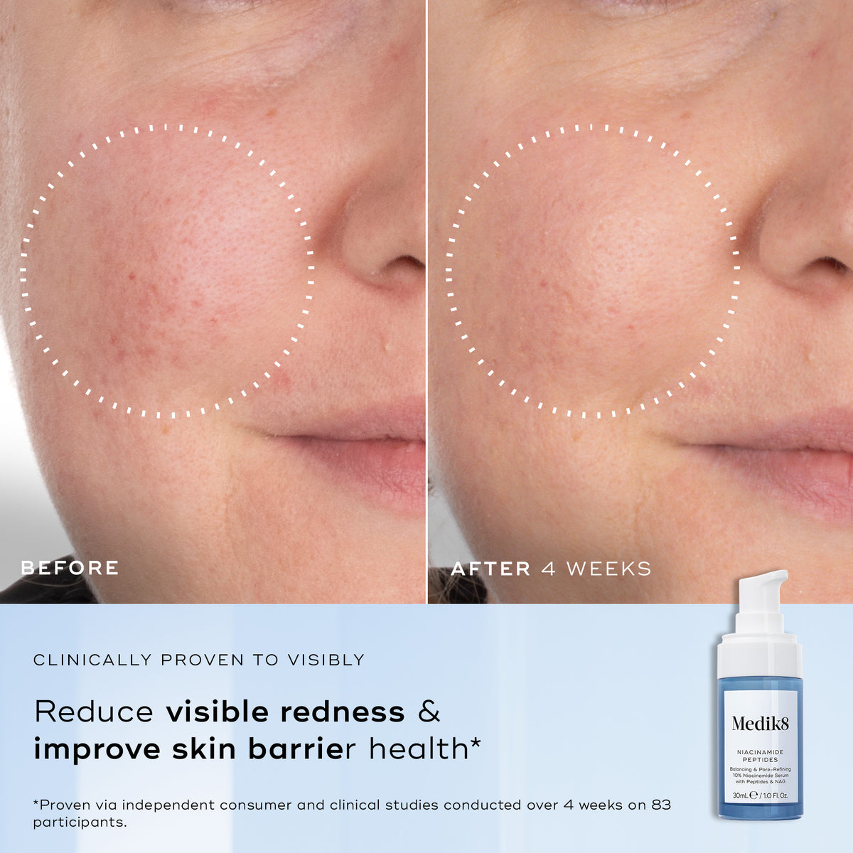 Medik8 Niacinamide Peptides before and after image showing visible redness and skin appearance after 4 weeks