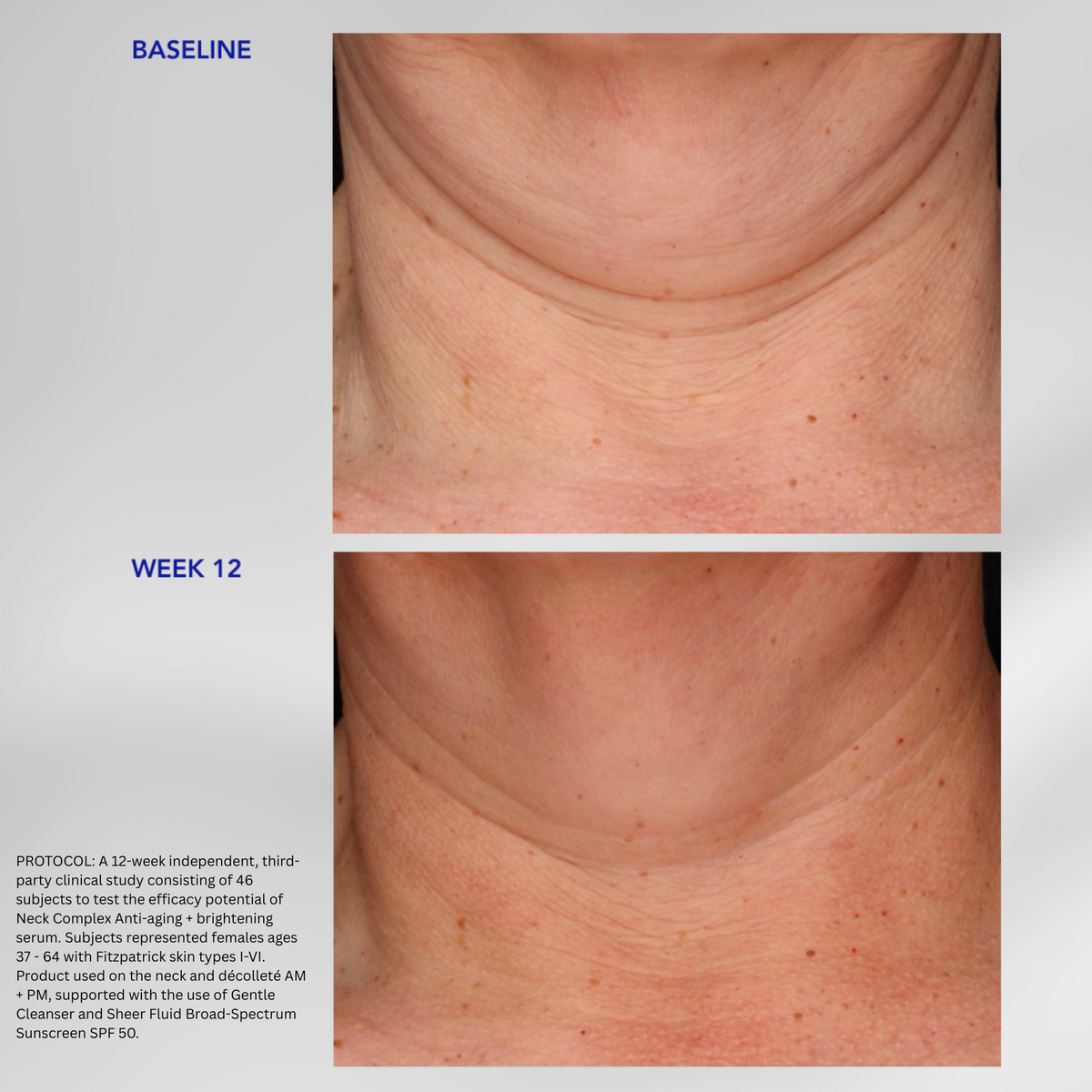 ZO Skin Health Neck Complex before and after image of the neck at baseline and week 12