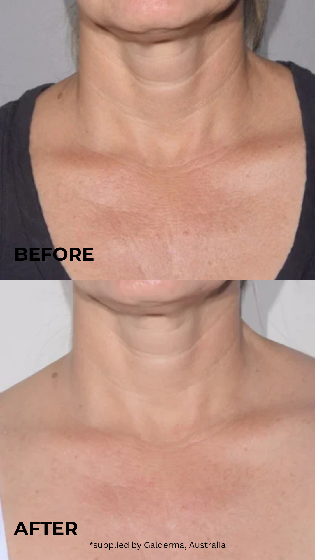Restorative Neck Complex with TriHex Technology