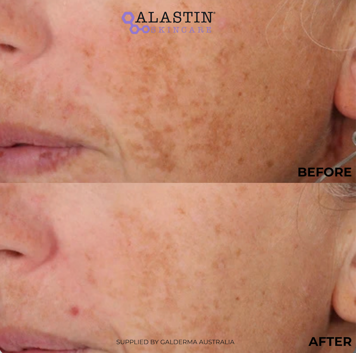 Before-and-after comparison of a person's cheek showing the reduction of sun damage, freckles, and hyperpigmentation. The top panel is labeled 'BEFORE' and shows darker brown spots on light skin.