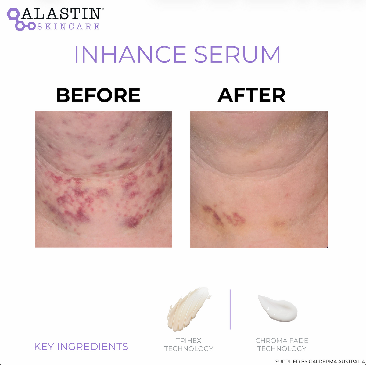 Before and after comparison of skin bruising and redness on the underarm area, demonstrating the effectiveness of Calastin Cosmetics Enhance Serum. Below the comparison, key ingredients Trihex Technology and Chroma Fade Technology are illustrated with cream swatches.