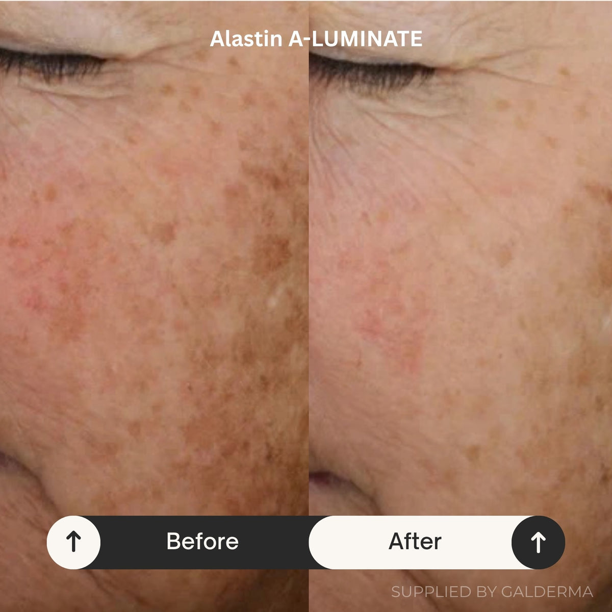 Before and after comparison of a person's cheek showing improvement in sun damage and hyperpigmentation, with the text 'Alastin A-LUMINATE' at the top and 'Before' and 'After' labels at the bottom.