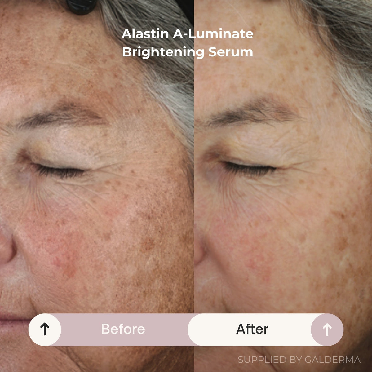 Before-and-after close-up of a woman's face showing skin brightening results, with the text 'Alastin A-Luminate Brightening Serum' and 'Before' and 'After' labels.