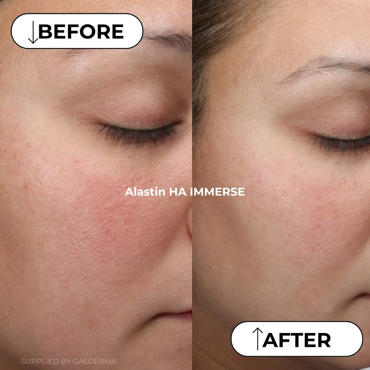 Before and after comparison of a person's cheek and eye area showing skin texture improvement, with text labels 'BEFORE', 'AFTER', and 'Alastin HA IMMERSE'.