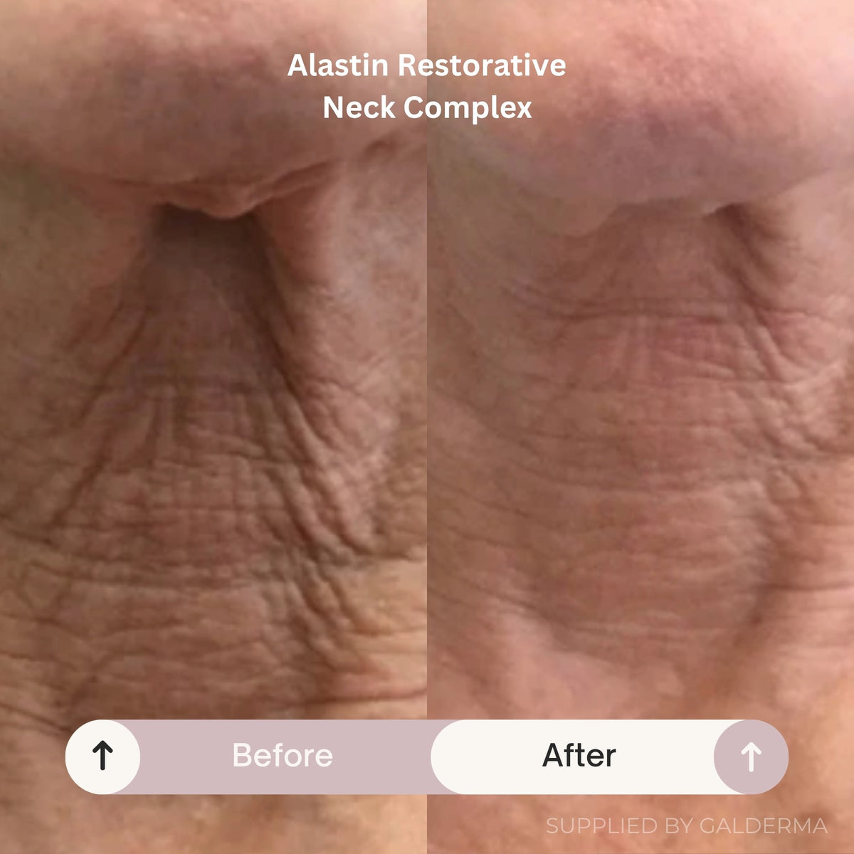 Before and After images of the Alastin Restorative Neck Complex