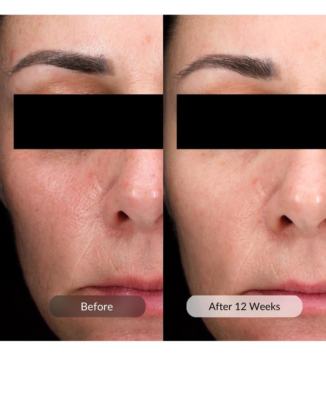 Revision Skincare D.E.J Daily Boosting Serum facial comparison labelled before and after 12 weeks.