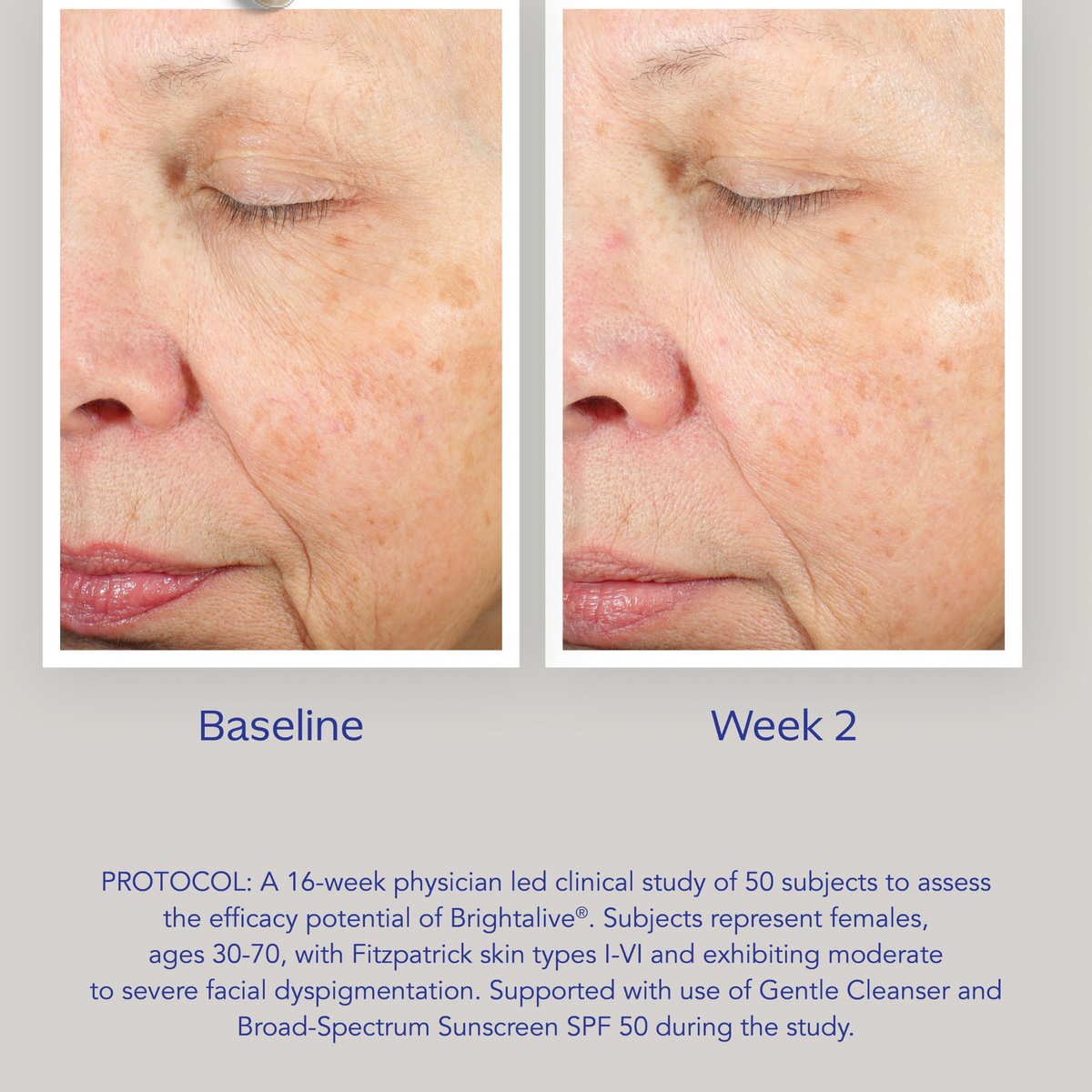 ZO Skin Health Brightalive Skin Brightener before and after image at baseline and week 2