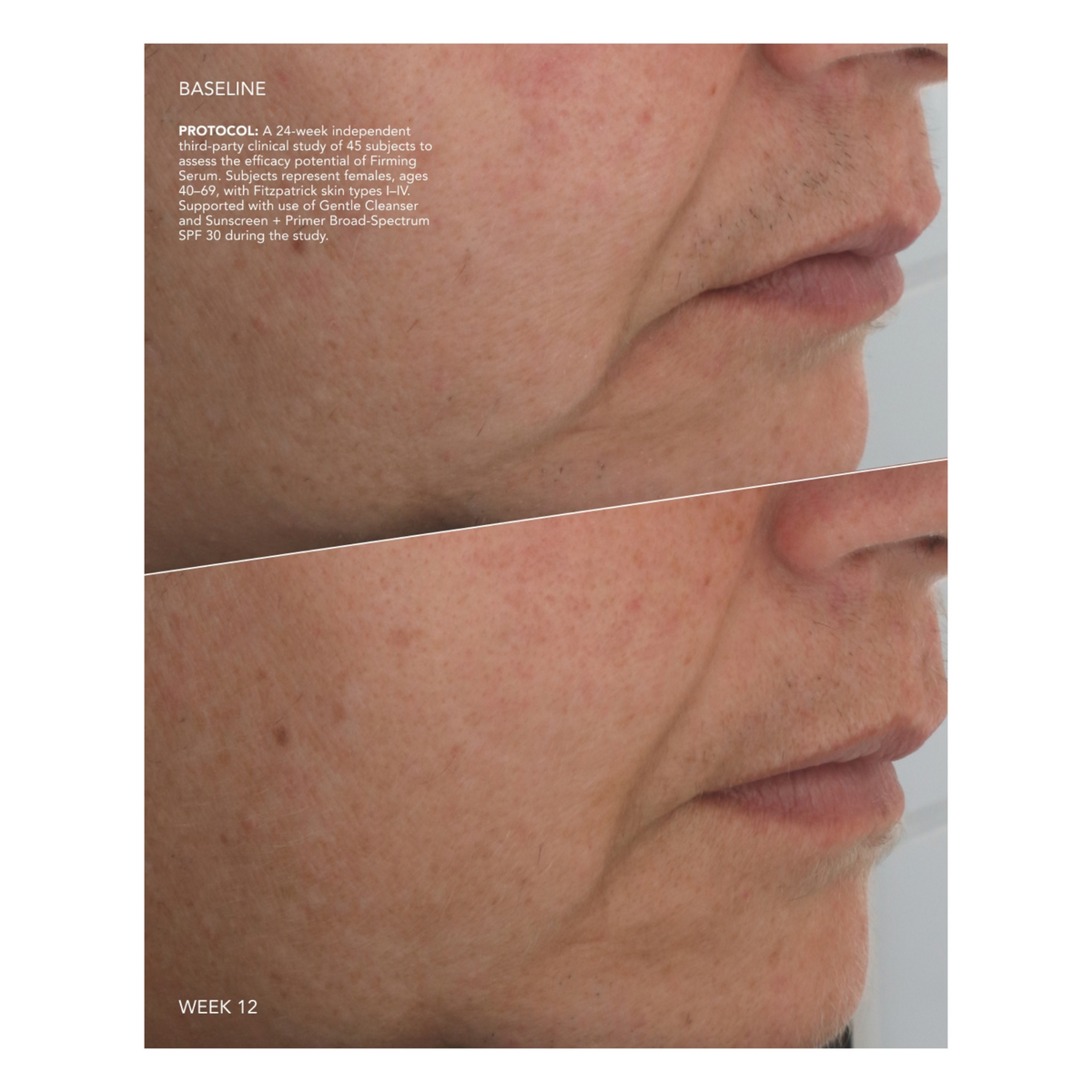 ZO Skin Health Firming Serum facial before and after image at baseline and week 12