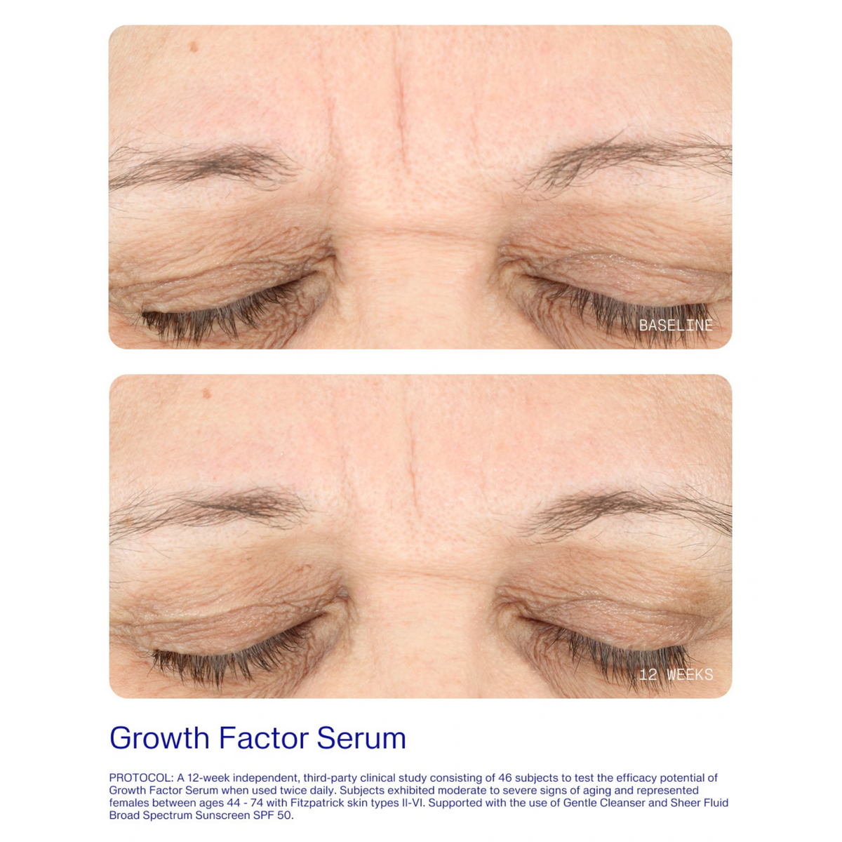 ZO Skin Health Growth Factor Serum before and after image of the eye area at baseline and week 12